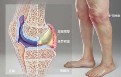 广州长安医院：日常生活中如何正确防治滑膜炎呢？